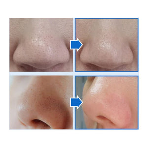MEDIPEEL Extra Super 9 Plus Blackhead Out Nose Pack 5ea, image 2